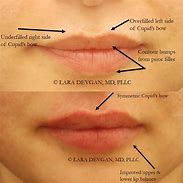 Image result for Chlamydia On Lips