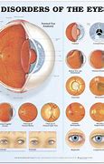 Image result for Traumatic Optic Neuropathy
