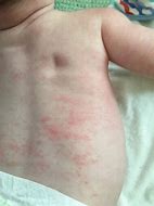 Image result for Baby First Food Allergy Rash