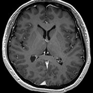 Image result for Choroid Plexus CT