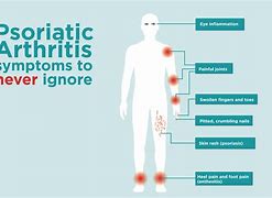 Image result for Psoriatic Arthritis Art