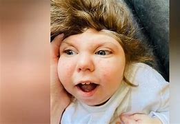 Image result for Baby Born without a Brain