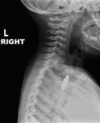 Image result for Normal Neck X-ray