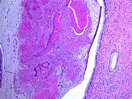 Image result for Nabothian Cyst Histology