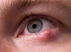 Image result for Eyelid Cyst Chichester