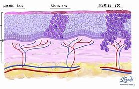 Image result for Squamous Cell Skin Cancer Diagram