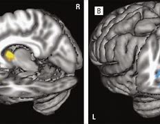 Image result for Brain Differences for BDD