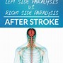 Image result for Paralysis Due to Stroke