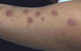 Image result for Autoimmune Blistering Disease
