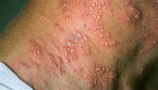 Image result for What Do Shingles Look Like