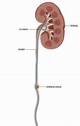Image result for 7Mm Kidney Stone Proximal in Ureter