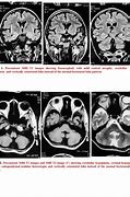 Image result for Cerebellar Dysplasia