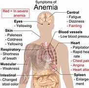 Image result for Sickle Cell Symptoms