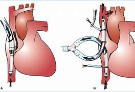 Image result for Cardiac Bypass Cannulation