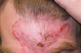 Image result for Untreated Basal Cell Carcinoma