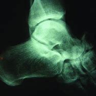 Image result for Tarsal Bone Fracture