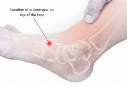 Image result for How to Remove Bone Spurs On Back of Ankle