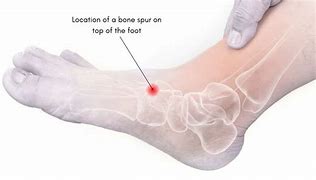 Image result for Bone Spur Ankle Pain