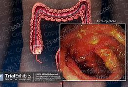 Image result for 5 mm Polyp in Colon