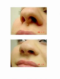 Image result for Wart On Nose Removal
