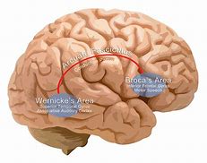 Image result for Aphasia Brain