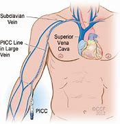 Image result for Blood Clot From PICC Line