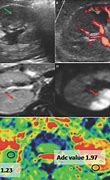Image result for Carotid Artery Doppler Ultrasound