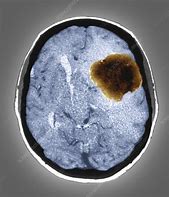 Image result for Benign Brain Tumor CT Scan