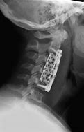 Image result for Cervical Spine Fusion Cage