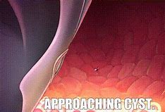 Image result for 5 Cm Ovarian Cyst Chart