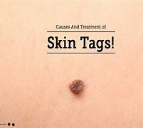 Image result for Papilloma Skin Tag