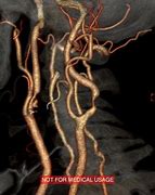 Image result for Carotid Sinus Stenosis