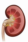 Image result for 9Mm Kidney Stone