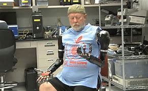 Image result for Prosthetic Arms