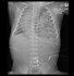 Image result for Diaphragm Hernia