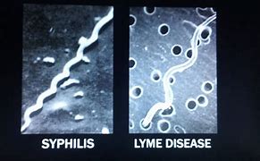 Image result for Syphilis Spirochete
