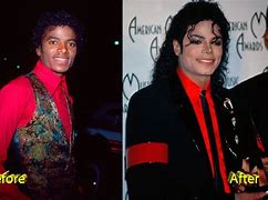 Image result for MJ Before and After Vitligo