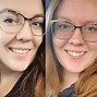 Image result for Byte Aligners Before and After