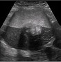 Image result for Dermoid Cyst vs Teratoma Ultrasound