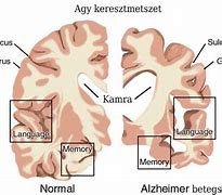 Image result for Alzheimer Kor