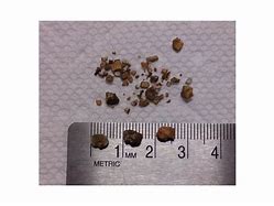 Image result for 2Mm Kidney Stone