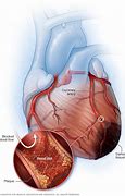 Image result for Heart Blood Vessels Blockage