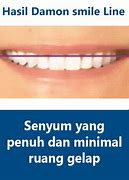 Image result for Damon Smile Indonesia