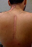Image result for Deep Back Scars