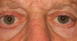 Image result for Basal Cell Carcinoma On Lower Eyelid