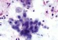 Image result for Metastatic Squamous Cell Carcinoma