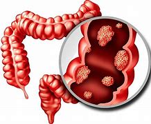 Image result for Picture of Cancer in Small Bowel