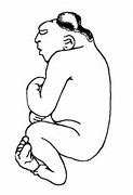 Image result for Anencephaly