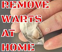 Image result for Removing Warts