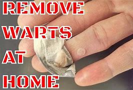 Image result for Wart Removal